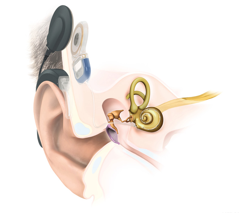 Explosionszeichnung eines Gehörgangs mit Cochlea-Implantat